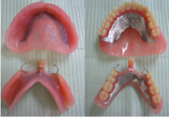 チタン床 義歯